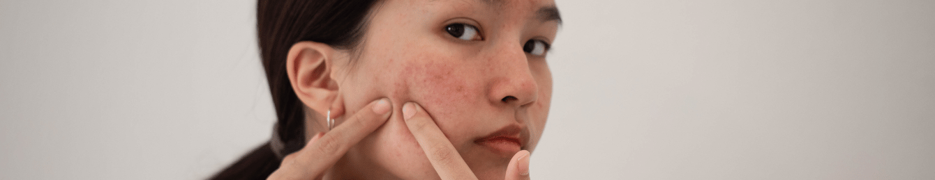 Bad Skincare Habit: Picking Acne